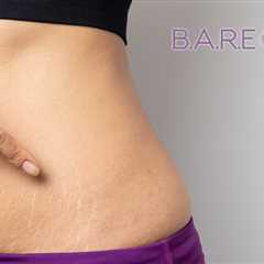 Stretch Mark Removal with IPL Treatments - B.A.R.E. Essentials Spa