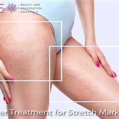 Laser Treatment for Stretch Marks in Windsor - B.A.R.E. Essentials Spa