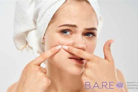 Best Acne Prevention Laser Treatment Tecumseh | BARE Essentials